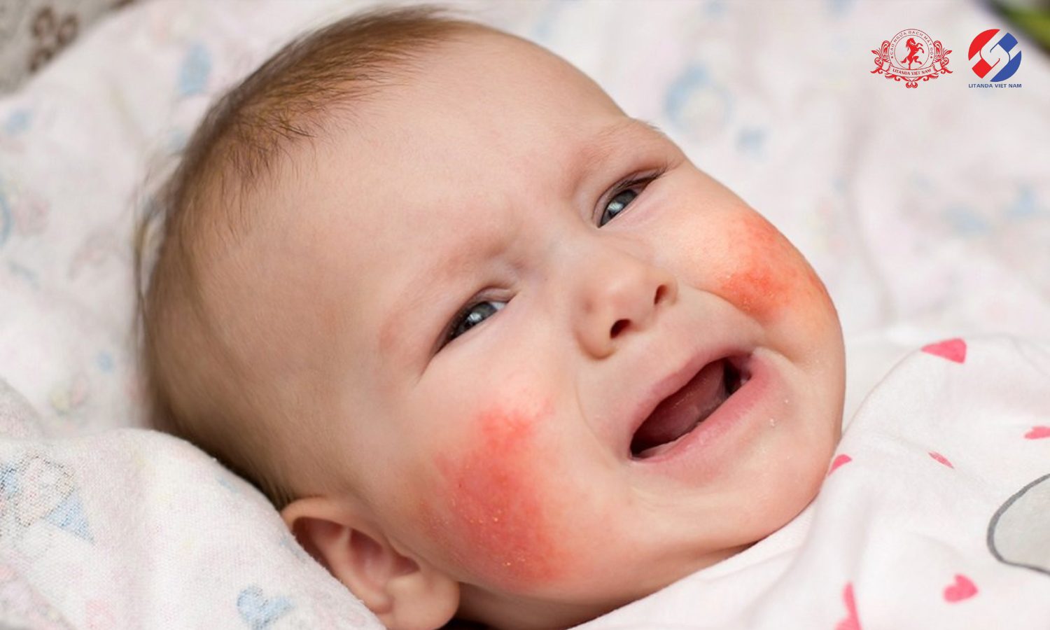 Phổi ngựa bạch ngâm mật ong giúp làm dịu các vấn đề về da mà trẻ đang gặp phải